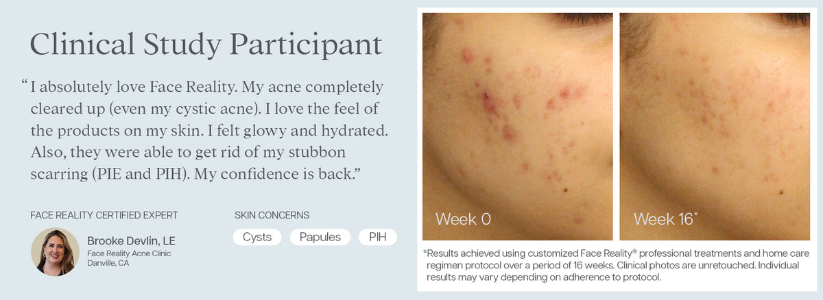 Face Reality Acne Clinic | Acne Treatment | San Francisco Bay Area